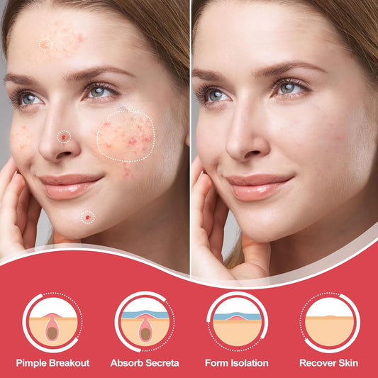 216 Counts Pimple Patches for Face, Hydrocolloid Acne Patches Zit Patches for Face Overnight Care Acne Spot Treatment Patch Cystic Acne Treatment Stickers Blemish Hydrocolloid Cover for All Skin Type